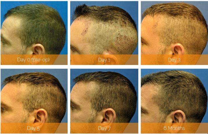Hair Transplant recovery